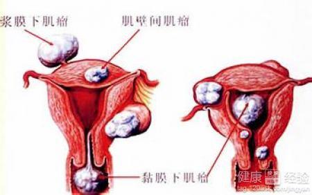 子宫肌瘤的最新最佳治疗方法解析